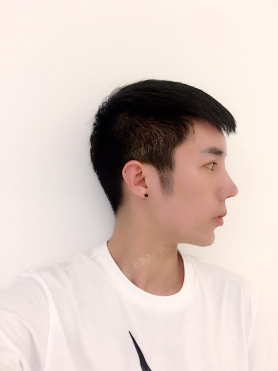 刘泽雨鼻部修复第46天美丽日记-新氧美容整形