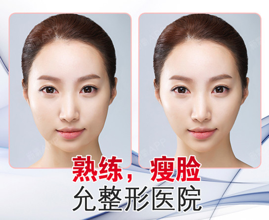 允整形瘦脸针---安全瘦脸很自然
