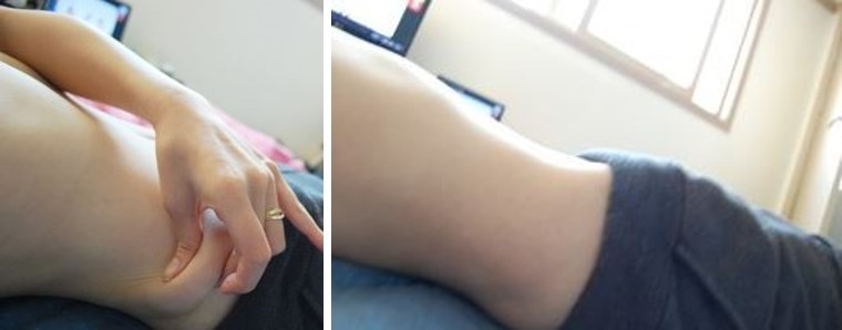 吸脂瘦腹部第399天