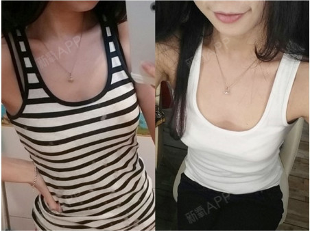 隆胸240cc大不大,假体隆胸240多大罩杯 手术部位:水滴型假体隆胸