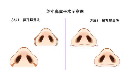 所以需不需要缩小鼻翼必须在行挺立鼻尖的手术后再评价判断.