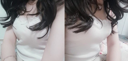 韩国整形案例分享V-LINE瓜子脸手术第243天美丽日记-新氧美容整形