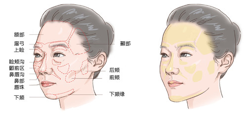 【全脸自体脂肪填充】自体脂肪全面部填充单次