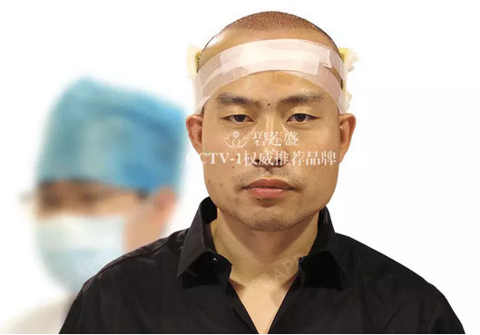 沈阳碧莲盛植发医院头顶加密种植第0天美丽日记-新氧美容整形