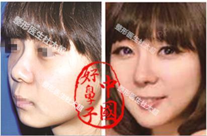 鼻部多项整形案例朝天鼻矫正膨体鼻部多项北京黄寺美容外科医院杜太超