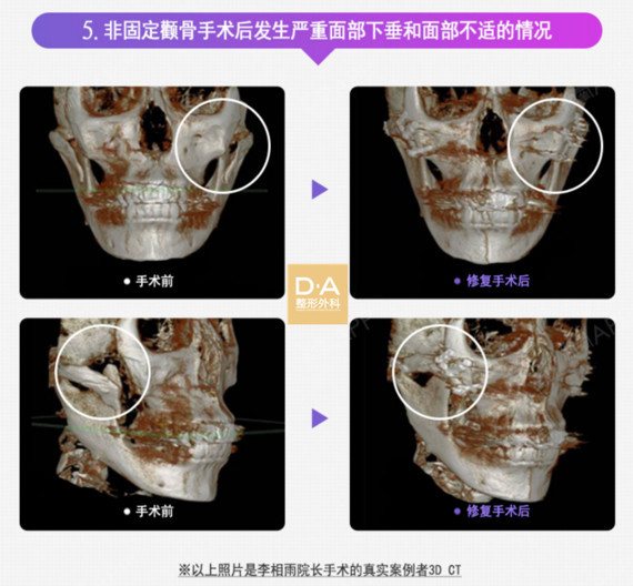 需要颧骨修复手术的情况