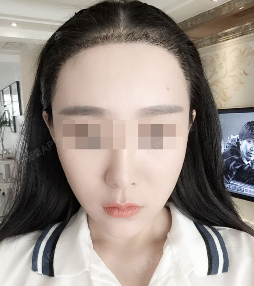 qq宝种植发际线第15天美丽日记