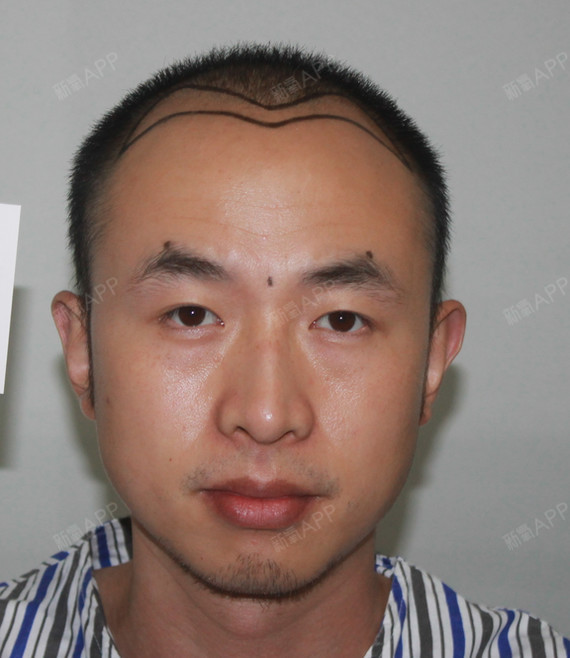 本人发际线很高 头发出油 而且有点自然卷 头部前边的