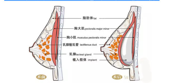 让胸部在坐卧跳立动静间随身姿自然波动,弧度自然,彰显动感韵律美