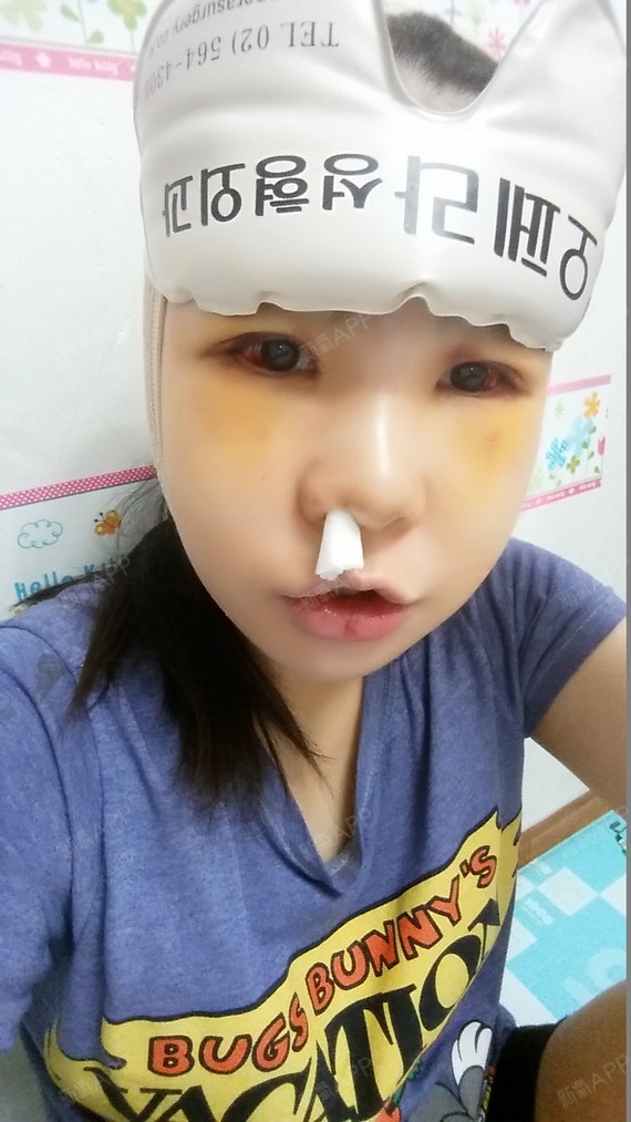 韩国欧佩拉整形外科颧骨内推第14天美丽日记