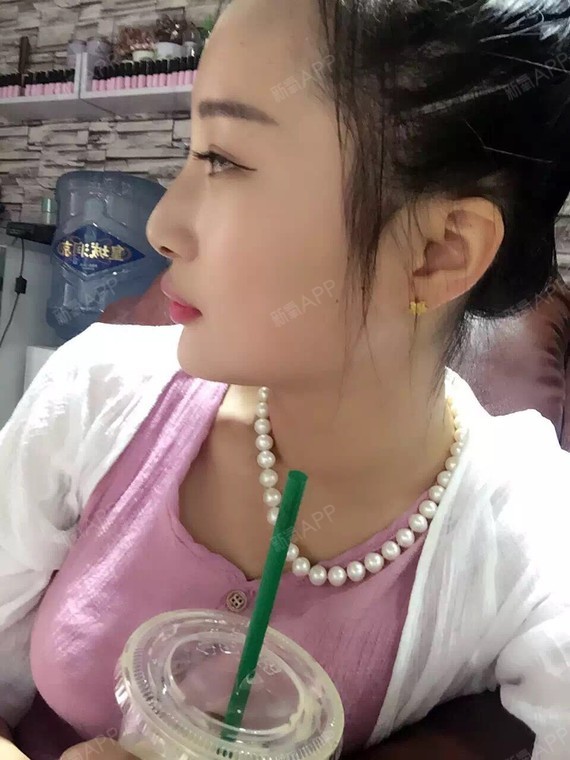 假体隆胸