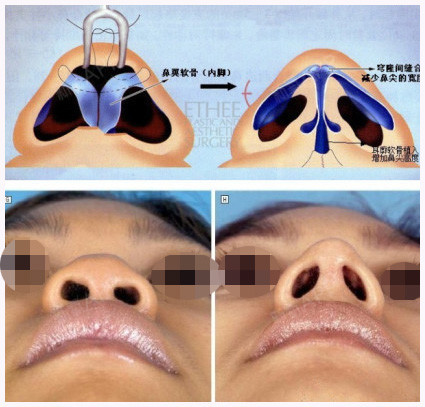 第一种是:鼻翼软骨宽大,内侧脚分离,手术切除部分软骨和皮下组织,将