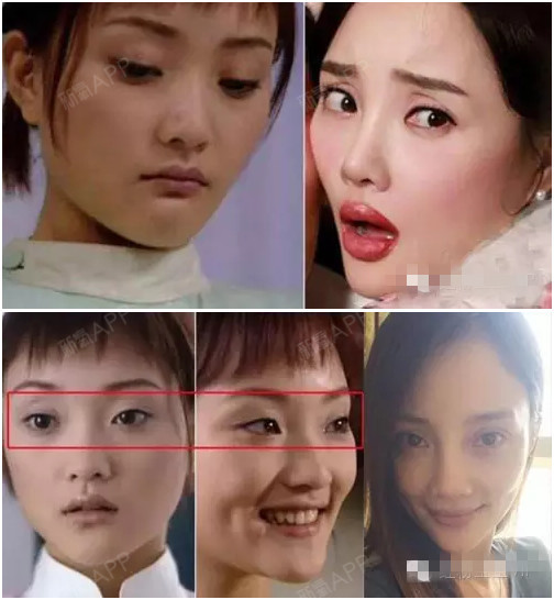 李小璐的鼻子原本挺可爱,不过为了迎合整容后的锥子脸,也做了鼻子