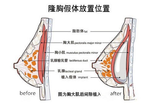 【拒绝流水线操作,定制专属你的蜜桃胸】—_圈子-新氧