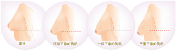 新氧 - SUJINCHOI | 美容美妆 | 胸部 | 隆胸 | 假体隆胸 | 自体脂肪隆胸 | 韩国整形 新氧 - SUJINCHOI | 美容美妆 | 胸部 | 隆胸 | 假体隆胸 | 自体脂肪隆胸 | 韩国整形