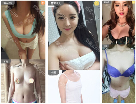 新氧 - SUJINCHOI | 美容美妆 | 胸部 | 隆胸 | 假体隆胸 | 自体脂肪隆胸 | 韩国整形 新氧 - SUJINCHOI | 美容美妆 | 胸部 | 隆胸 | 假体隆胸 | 自体脂肪隆胸 | 韩国整形