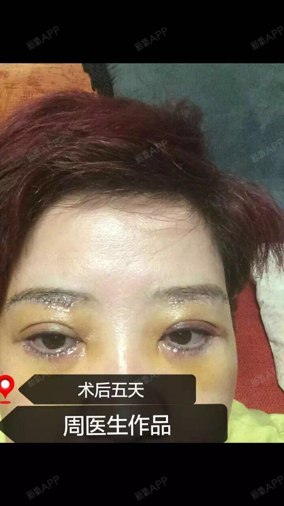 眼袋提眉术,在刚刚做完手术的时候,眼袋还不是很平