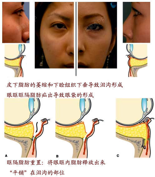 眶隔释放法原理(图片来自于网络)   适应症