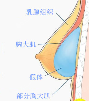 慈溪隆胸费用圣爱明理