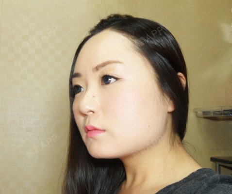 【瘦脸针多久有效果?真人案例】