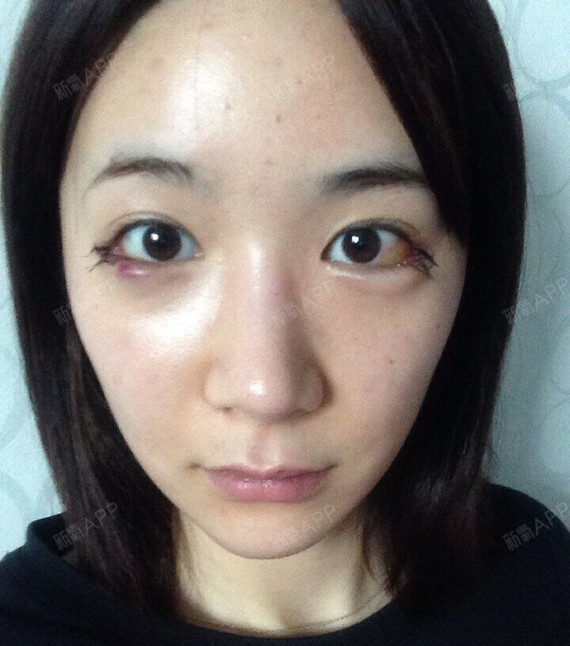 去做开外眼角,我的眼睛本身基础还行吧,有双眼皮的,就是眼尾比较上翘