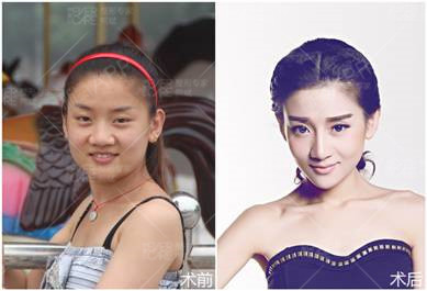 魔丽美人计第二季选手 陈艾琳   具体术式:美人弧假体隆鼻,海鸥线