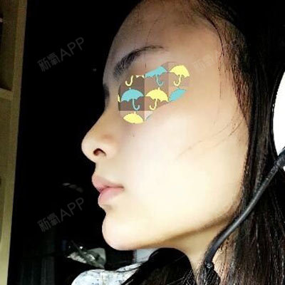 特别满意~~~正面像兜财下巴 侧面轮廓更好啦