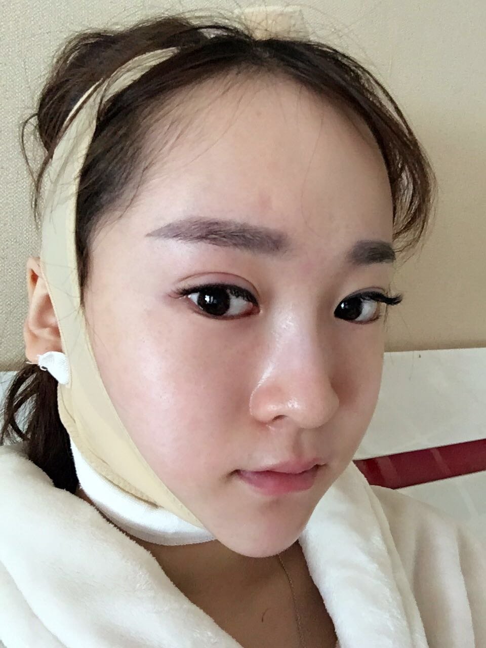 面部吸脂第5天
