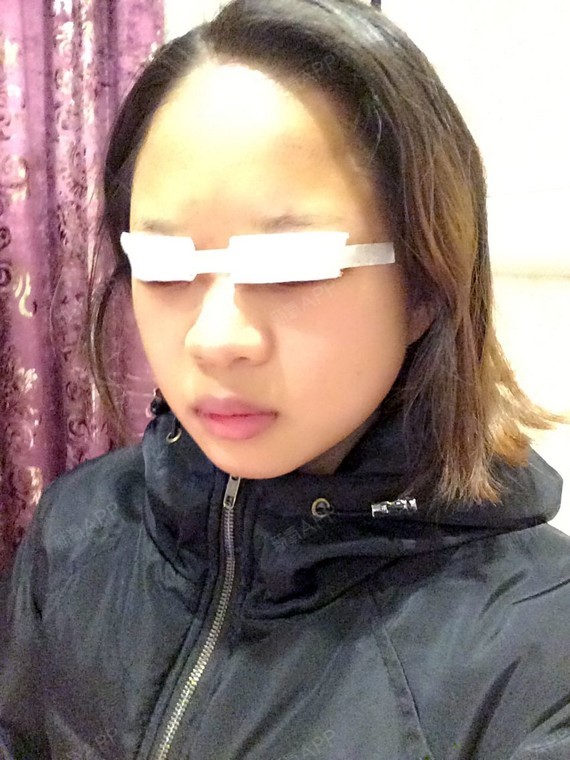 眼部修复