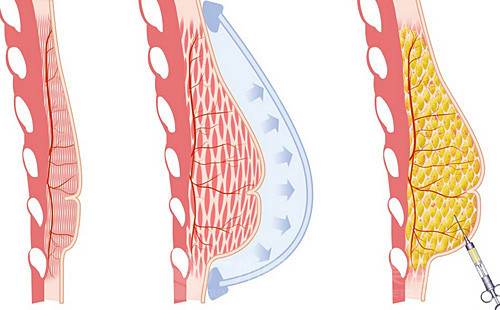 这里讲的注射式隆胸是通过注射玻尿酸,爱贝芙等填充物来改善乳房的
