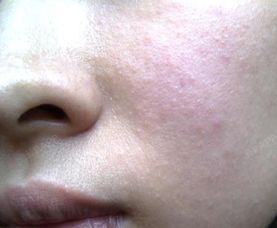 其实脱皮是皮肤严重缺水的症状,皮肤缺水导致脱皮是因为脸上角质层