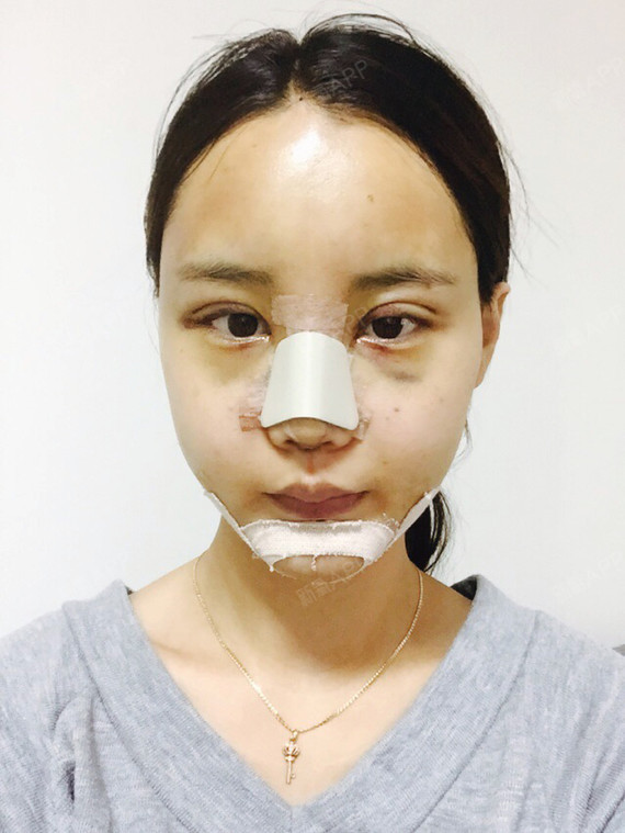 井超自体脂肪全脸填充第4天美丽日记-新氧美容