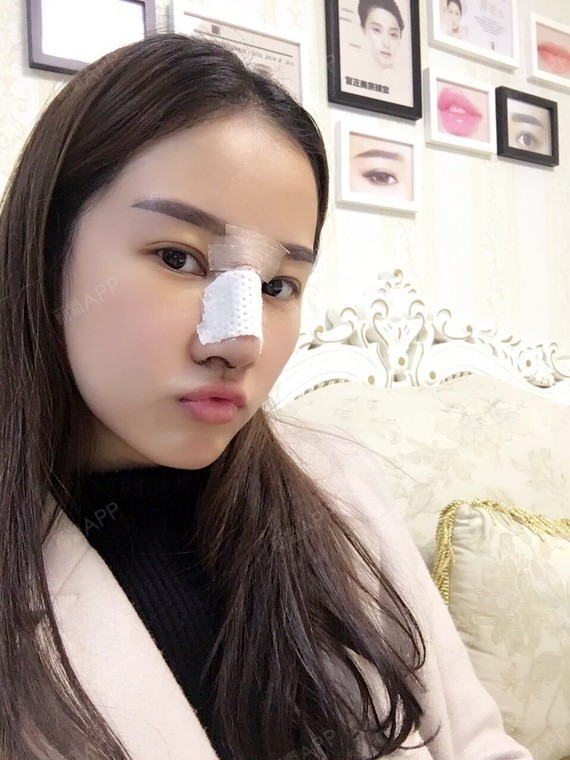 肋软骨隆鼻