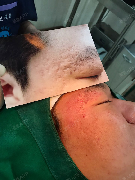 凹陷疤痕接受多次激光治疗也不会有明显的改善,但自体真皮再生术一次