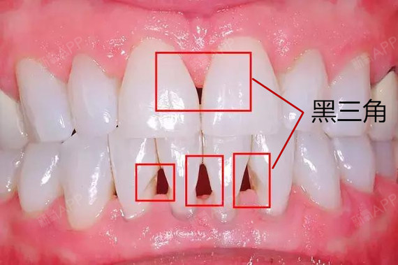 【深度解析】牙齿矫正"黑三角"到底有多可怕?