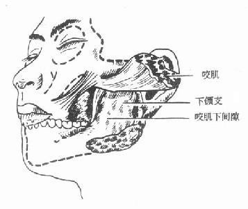 咬肌切除手术采用微创技术,在口腔内做切口,从外表上不会看出来.