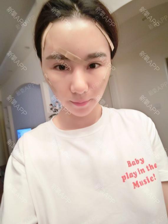 泰国电话单身女人美女脂肪全脸填充第1天美丽自体头发东丰图片