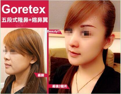 goretex五段式隆鼻,玲珑有致的鼻型超级棒呢选