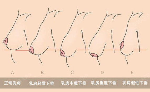 2,根据乳房下皱襞与乳房下极的关系,把乳房下垂分为4种类型