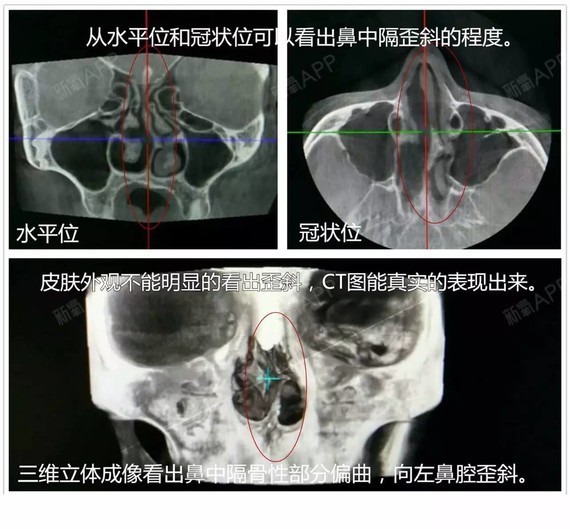术前分析:妹子最突出的问题是鼻中隔偏曲造成呼吸不畅,鼻尖左偏,ct图