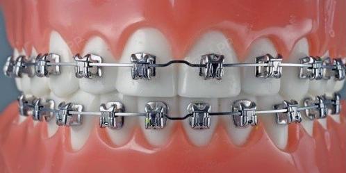 牙齿矫正的方法多样,你该怎么分辨?