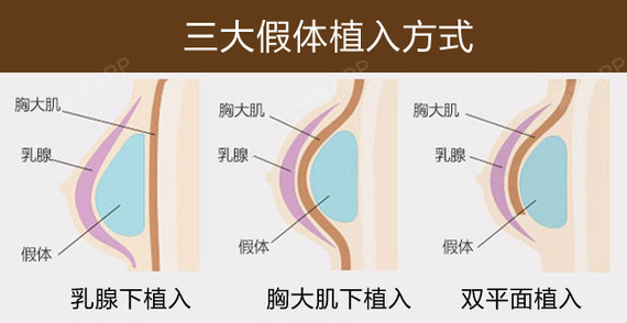芭比弧线塑造精致美胸郑州水晶芭比梦美容医_圈子