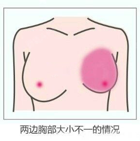 丰胸#哺乳期过后大龄女性乳房一大一小,简单的按摩