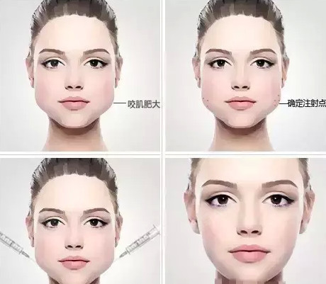 切除咬肌还是打瘦脸针,你选哪个