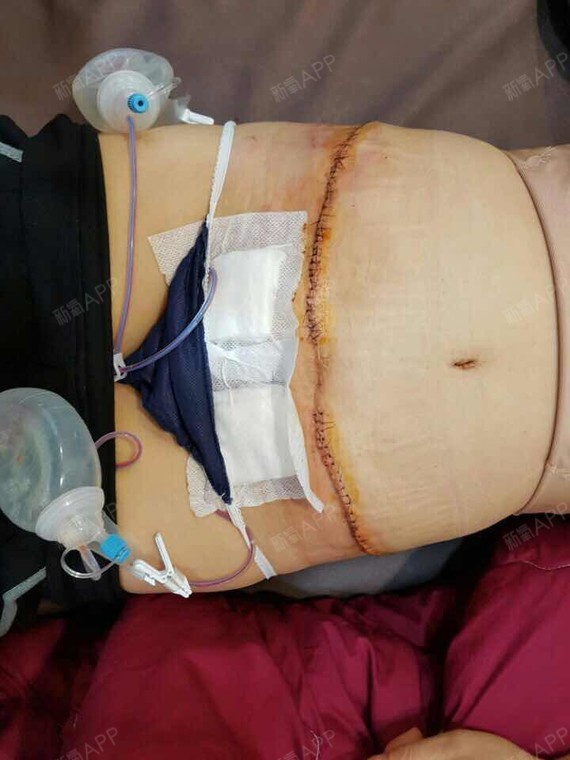 丽颖整形外科腹壁成形术第5天美丽日记-新氧美容整形