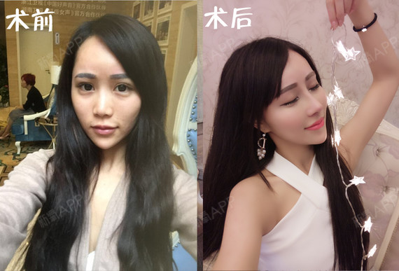 新氧 - 氧气姐 | 隆鼻 | 膨体隆鼻 | 整形纯干货 新氧 - 氧气姐 | 隆鼻 | 膨体隆鼻 | 整形纯干货