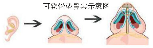 新氧 - 氧气姐 | 隆鼻 | 膨体隆鼻 | 整形纯干货 新氧 - 氧气姐 | 隆鼻 | 膨体隆鼻 | 整形纯干货