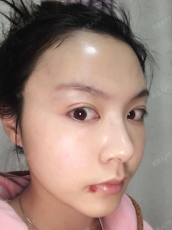 本姑娘年前做的自体脂肪填充的太阳穴,额头,眉心,赶_圈子-新氧美容