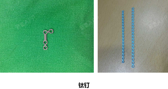 整形新技术】"3d颧骨回转术",半个小时_圈子-新氧美容