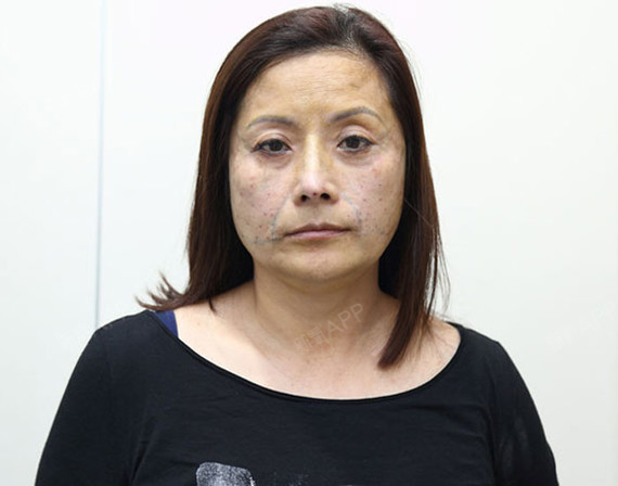 这是刚做完线雕术后的效果图,脸上密密麻麻的针眼,都是手术时埋线
